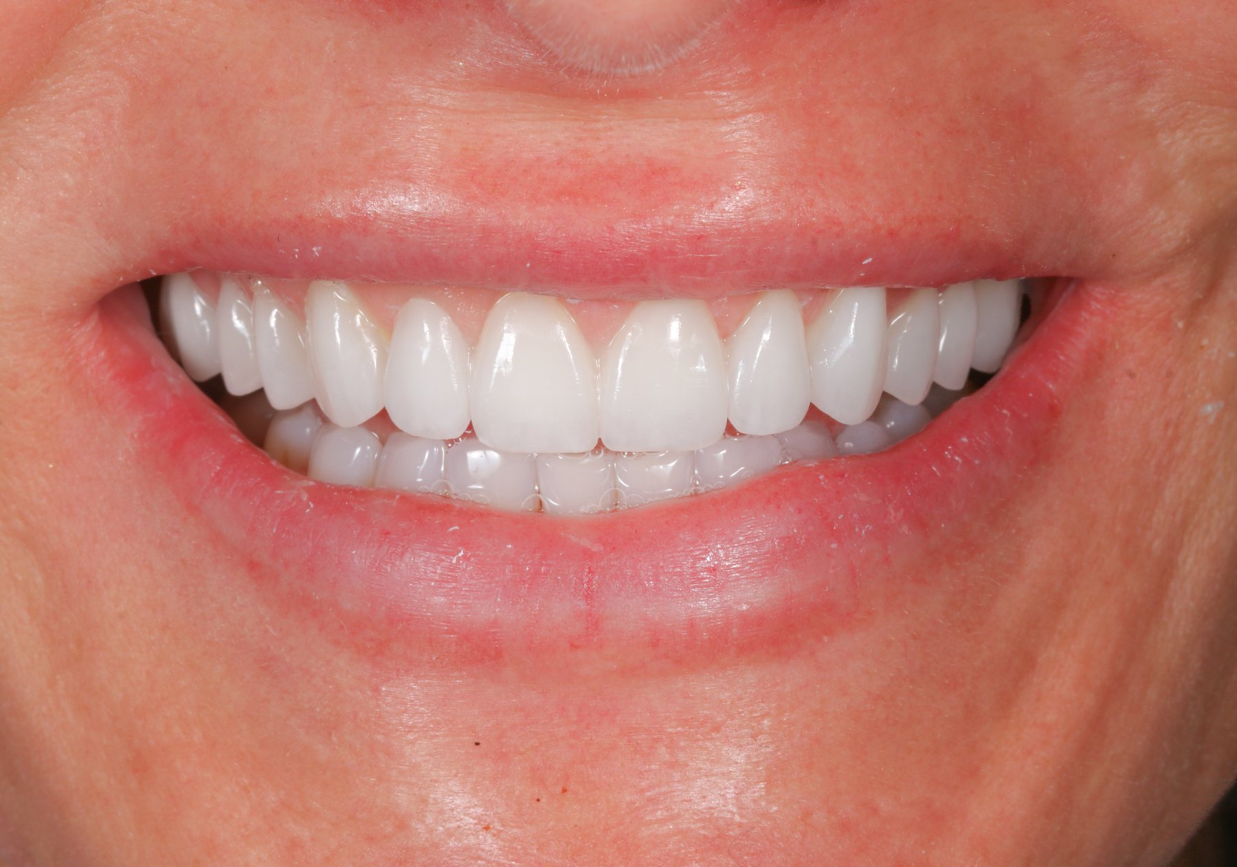 Delivered smile · ceramic translucency