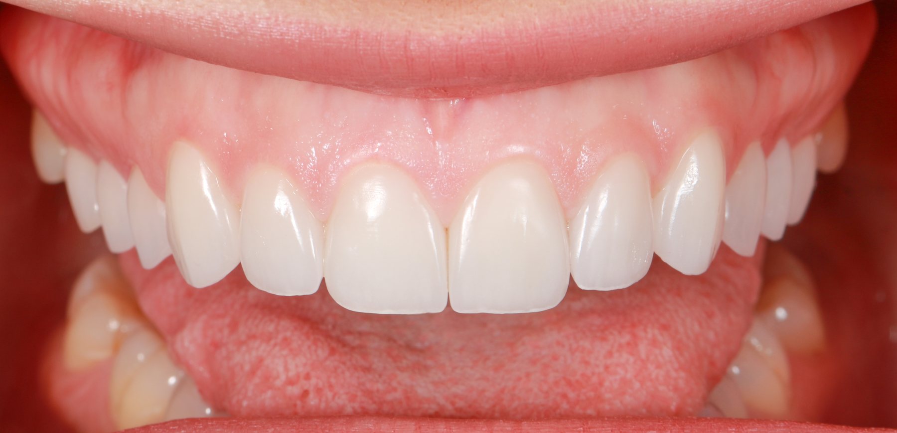 Delivered smile · veneer aesthetics