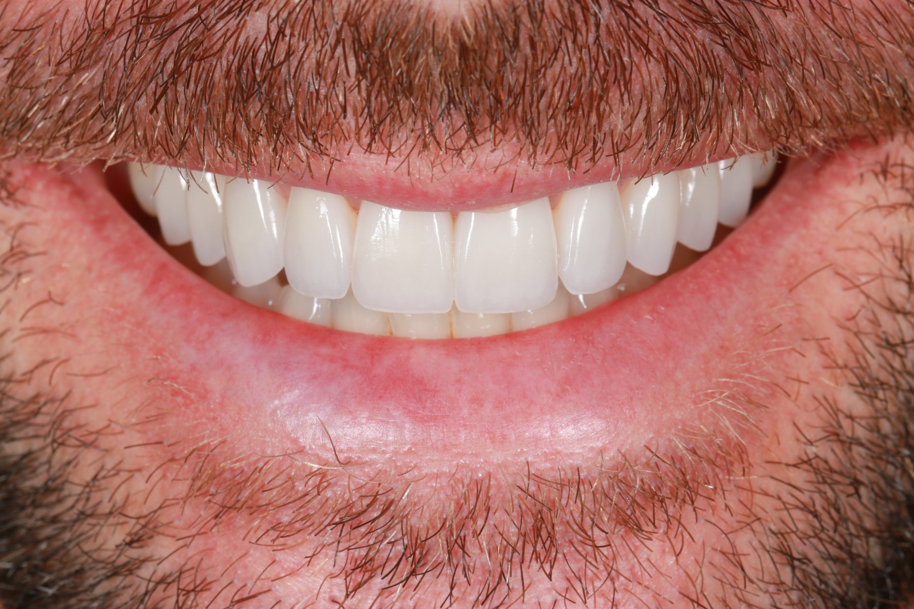 Delivered smile · veneer aesthetics
