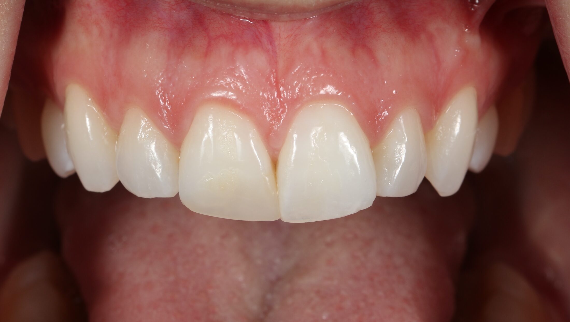 Smile before porcelain veneers