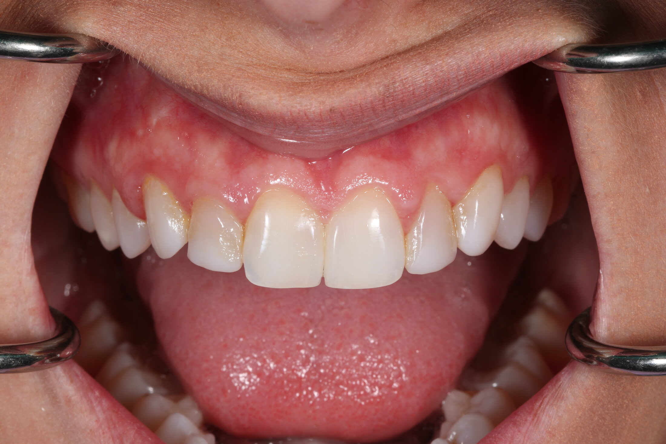 Aged composite bonding on anterior teeth