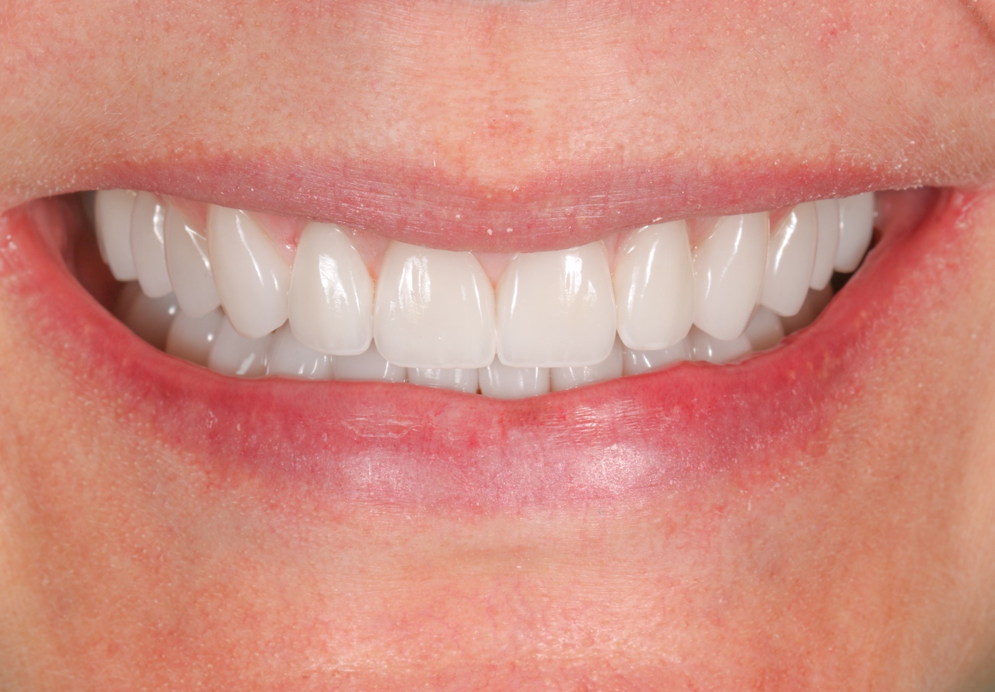 Smile after veneers &mdash; brighter, balanced color