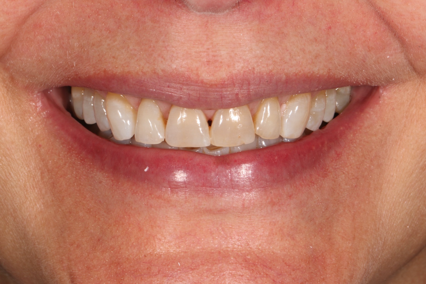 Smile before veneers &mdash; improving color and brightness