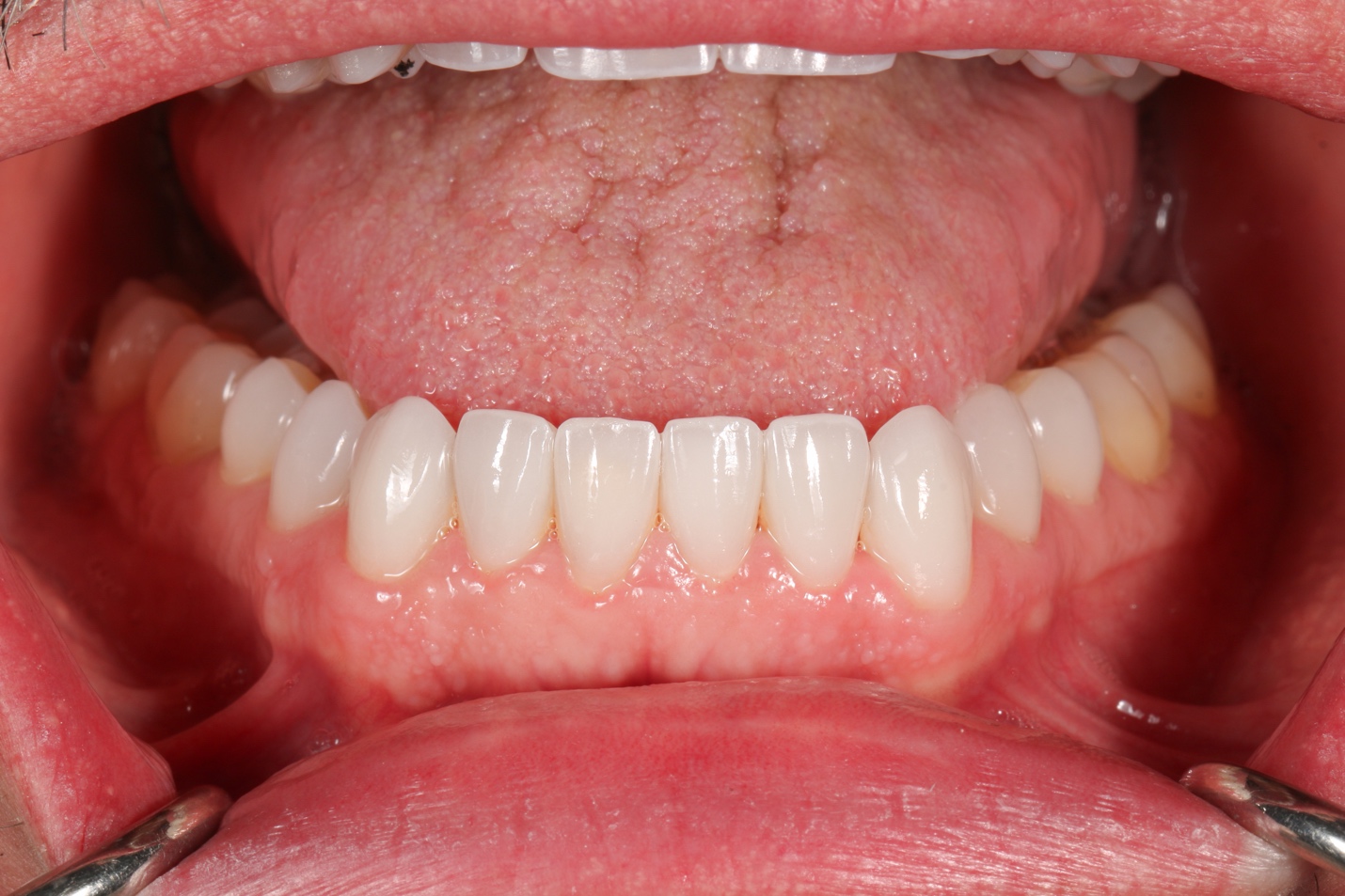 Smile after veneers &mdash; restored alignment