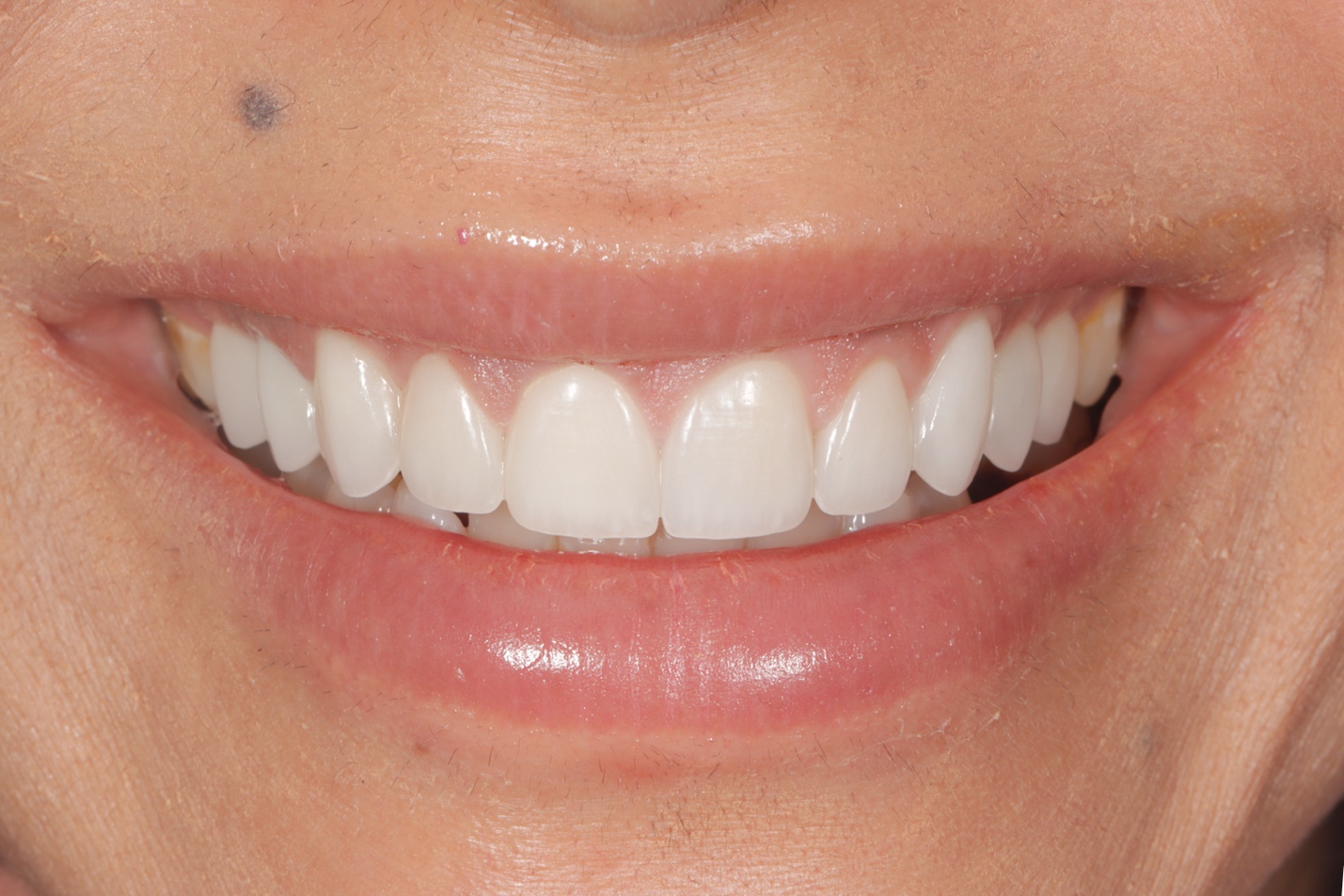 Smile after veneers &mdash; refreshed with new restorations