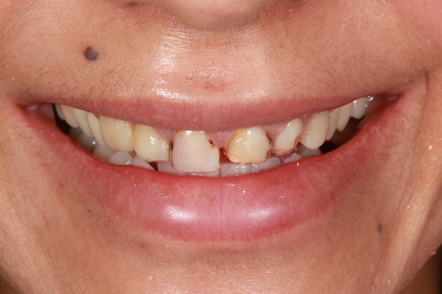 Smile before veneers &mdash; replacing aged bonding and old veneers