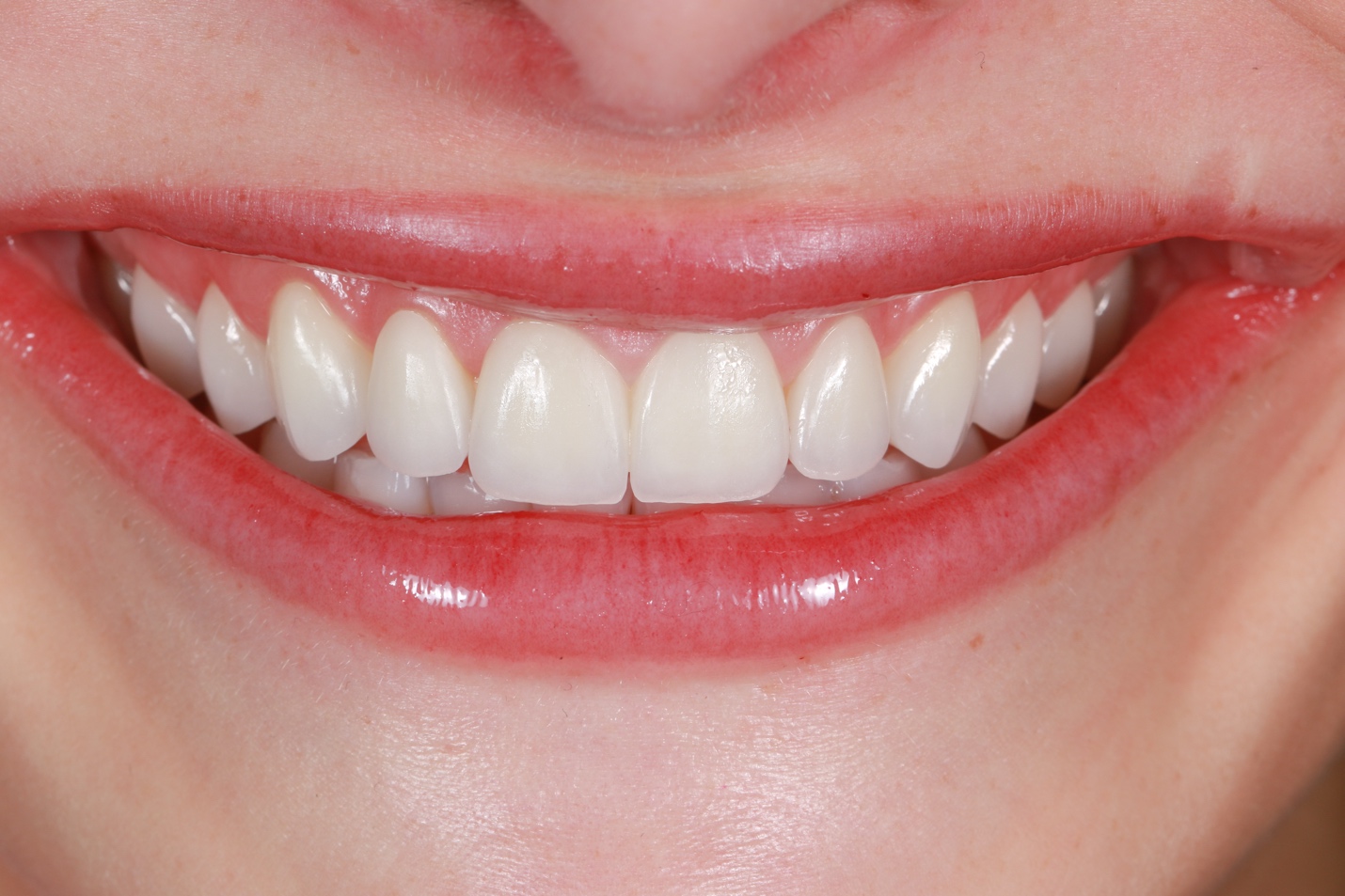 Smile after veneers &mdash; worn edges restored