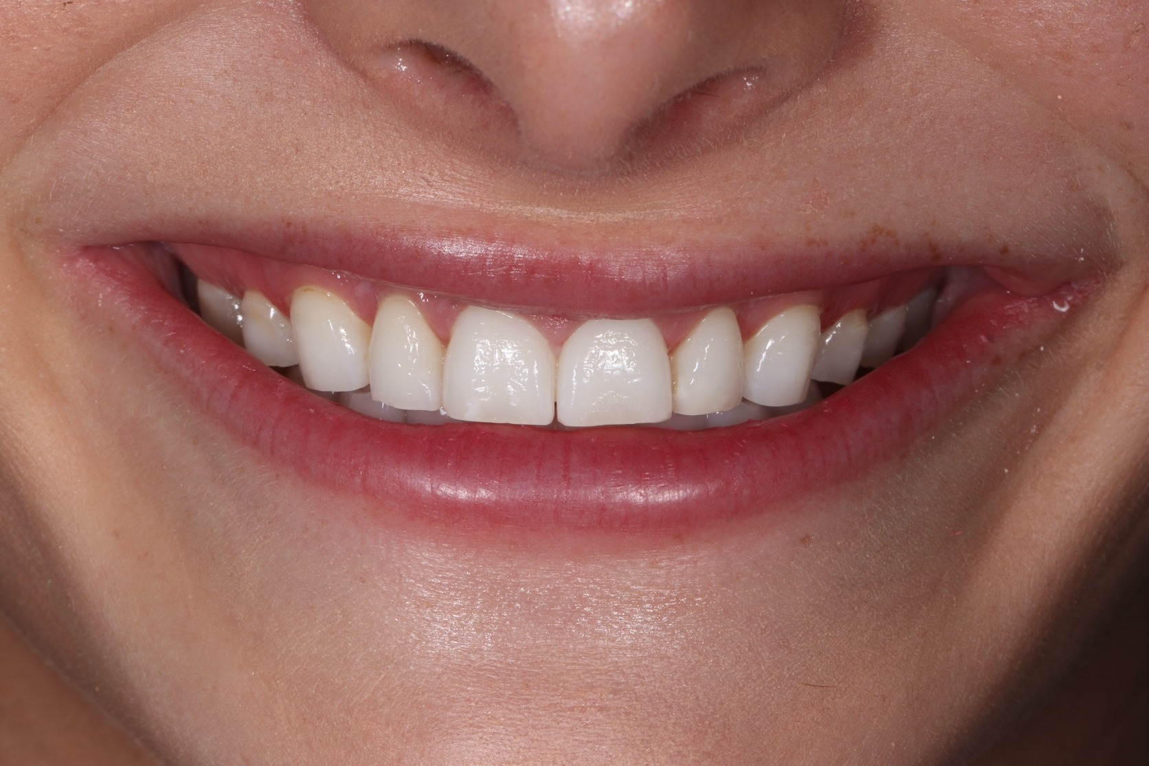 Smile before veneers &mdash; restoring worn and chipped edges