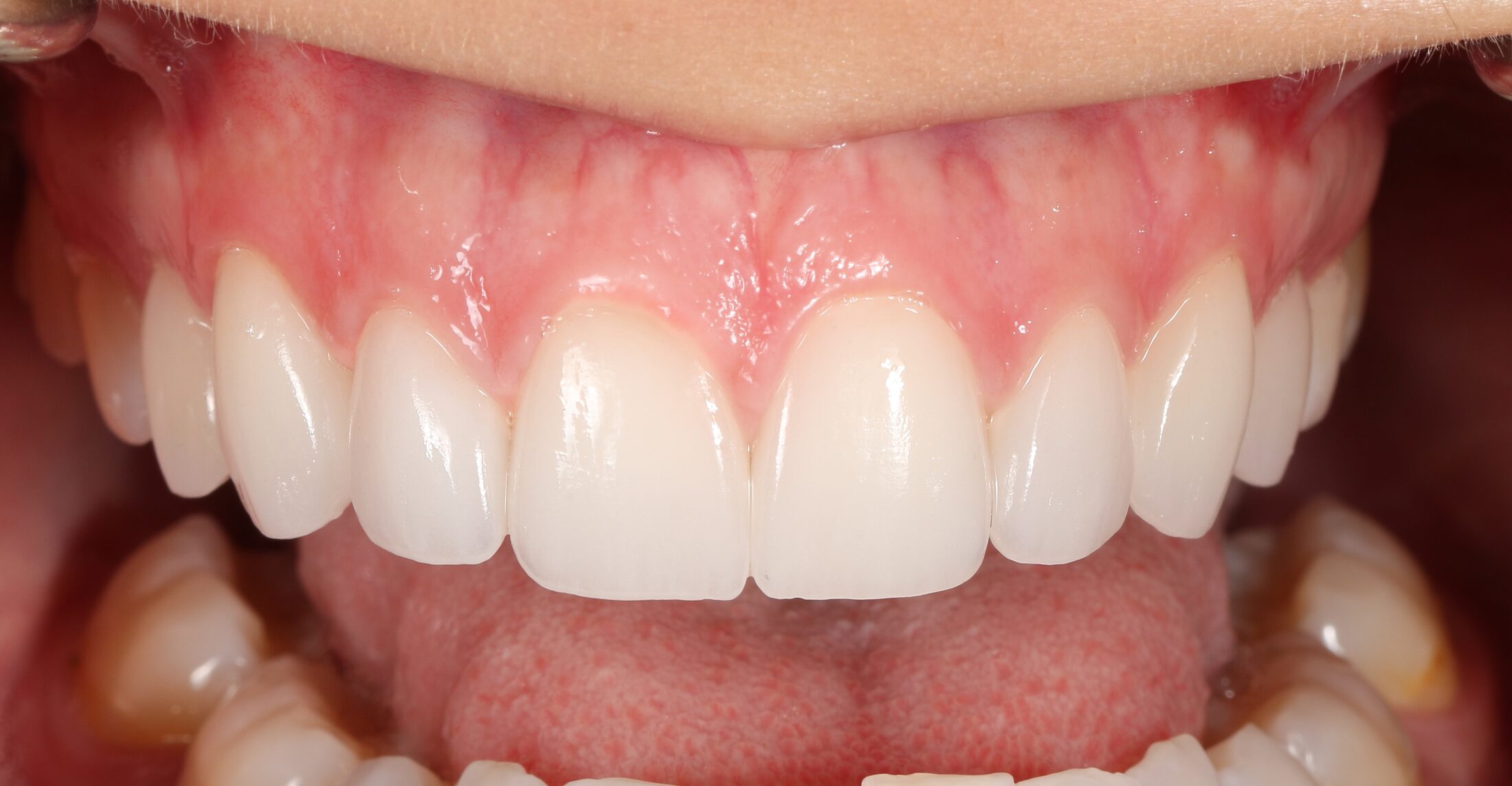 A completed veneer case by Dr. Schelkopf